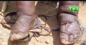 Mu Karere ka Gicumbi bibasiwe n’indwara ibarembeje yo kubyimba amaguru izwi nk’imidido, hari abavuga ko iterwa n’amarozi