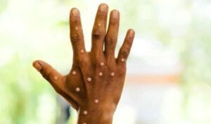 Byinshi ku ndwara y’ubushita bw’inkende yageze mu Rwanda n’uko wakwirinda kuyandura